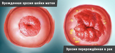 Нет диагноза эрозия шейки матки